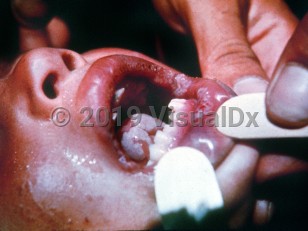 Clinical image of Endemic syphilis
