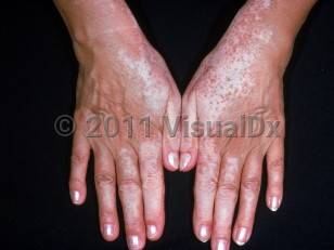 Clinical image of Drug-induced hypopigmentation - imageId=2200832. Click to open in gallery.  caption: 'Depigmented macules and patches on the dorsal hands, secondary to use of medication that was applied to the face. '