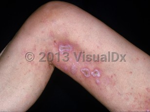 Clinical image of Drug-induced skin ulcers