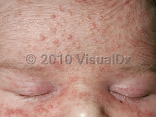 Clinical image of Neonatal acne - imageId=221053. Click to open in gallery.  caption: 'Multiple tiny pustules and papules and a few interspersed closed comedones, on a background of erythema on the central face.'