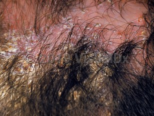 Clinical image of Favus - imageId=2213445. Click to open in gallery.  caption: 'Diffuse thick, whitish, yellowish and light brown concretions, crusting, and interspersed hair loss on the scalp.'