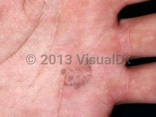 Clinical image of Tinea nigra - imageId=2215789. Click to open in gallery.  caption: 'Dark brown macules and patches with a speckled appearance on the palm.'
