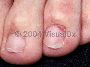 Clinical image of Periungual fibroma - imageId=2219381. Click to open in gallery.  caption: 'Patient with diagnosed TSC and soft, skin-colored, grouped papules near the cuticle of the toenail.'