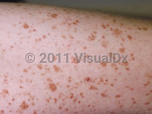 Clinical image of Capillaritis - imageId=221951. Click to open in gallery.  caption: 'Multiple tiny, cayenne pepper-type petechiae and golden-brown macules on the thigh.'
