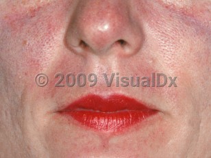 Clinical image of Carcinoid syndrome - imageId=2219774. Click to open in gallery.  caption: 'Red and lightly violaceous patches on the central face.'
