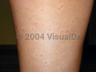 Clinical image of West Nile virus - imageId=2220835. Click to open in gallery.  caption: 'Numerous tiny, erythematous papules, each with a surrounding blanched halo, on the leg.<br/><br/>Image source: Centers for Disease Control and Prevention (CDC). This image is in the public domain and thus free of any copyright restrictions.'