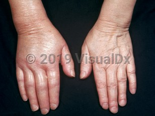 Clinical image of Buerger disease - imageId=2221719. Click to open in gallery.  caption: 'Edema of the right hand and fingers (early edematous phase).'