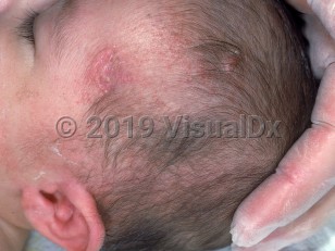 Clinical image of DiGeorge syndrome