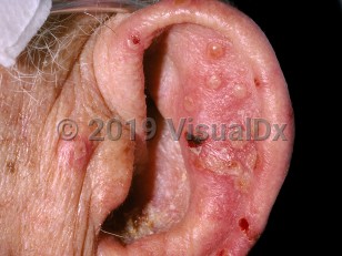 Clinical image of Disseminated herpes simplex virus - imageId=222911. Click to open in gallery.  caption: 'Scattered vesicles and crusts on and around the ear.'
