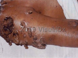 Clinical image of Rhinosporidiosis
