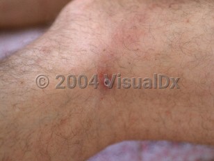 Clinical image of Mediterranean spotted fever - imageId=2236963. Click to open in gallery.  caption: 'A thickly crusted papule with surrounding erythema and scattered faint pink macules and papules on the leg.'