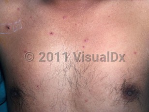 Clinical image of Talaromyces marneffei infection - imageId=2237809. Click to open in gallery.  caption: 'Numerous erythematous papules, some umbilicated, scattered on the chest of a patient with HIV.'