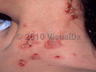 Clinical image of Pemphigus vegetans - imageId=223843. Click to open in gallery.  caption: 'Flaccid vesicles, some cloudy, with surrounding erosions and crusting, on the lateral neck.'