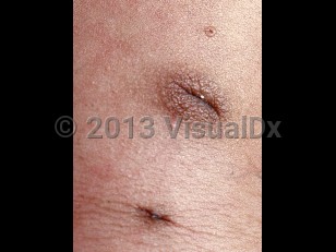 Clinical image of Supernumerary nipple - imageId=2247680. Click to open in gallery.  caption: 'Brown papules superior and inferior to the nipple / areola complex.'