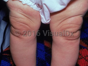 Clinical image of Cutis laxa - imageId=2252022. Click to open in gallery.  caption: 'Folds of skin over the thighs and knees.'