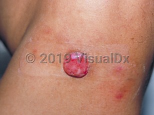 Clinical image of Merkel cell carcinoma - imageId=227416. Click to open in gallery.  caption: 'A close-up of an eroded pink nodule.'
