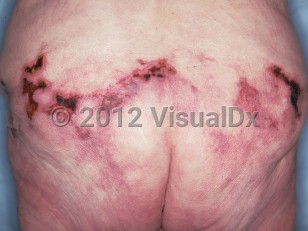 Clinical image of Cholesterol emboli - imageId=227719. Click to open in gallery.  caption: 'Retiform eschars with surrounding retiform violaceous patches and plaques on the buttocks.'