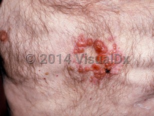 Clinical image of Metastatic cutaneous carcinoma - imageId=227875. Click to open in gallery.  caption: 'A cluster of shiny reddish papules and nodules on the central chest.'
