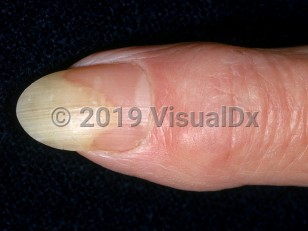 Clinical image of Onycholysis - imageId=2281151. Click to open in gallery.  caption: '<span>Distal, dull yellow-white discoloration of the fingernail representing areas of loss of attachment of the nail plate to the nail bed after use of artificial nails.</span>'