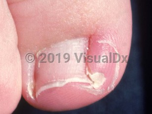 Clinical image of Ingrown toenail - imageId=2285888. Click to open in gallery.  caption: 'Lateral ingrowing toenail, with adjacent pink erythema and edema of the nail fold (paronychia).'