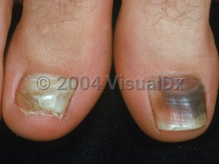 Clinical image of Subungual hematoma - imageId=2292687. Click to open in gallery.  caption: 'Deep purple and reddish discoloration of the great toenail, and onychodystrophy of the other great toenail.'