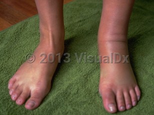 Clinical image of Loiasis - imageId=229728. Click to open in gallery.  caption: 'Marked lymphedema of the left leg.'