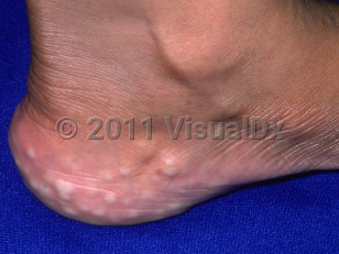 Clinical image of Piezogenic papules