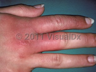 Clinical image of Erysipeloid - imageId=230835. Click to open in gallery.  caption: 'An edematous, erythematous plaque on the dorsal hand and fingers.'