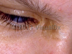 Clinical image of Homocystinuria - imageId=231225. Click to open in gallery.  caption: 'Pigmentary dilution of skin and blue eye color.'