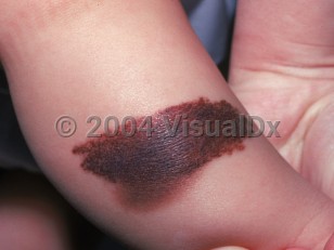 Clinical image of Congenital melanocytic nevus - imageId=2314374. Click to open in gallery.  caption: 'A large variegated, reddish, and brown plaque on the leg.'