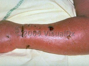 Clinical image of Pasteurella multocida infection - imageId=231900. Click to open in gallery.  caption: 'Diffuse erythema and edema on the hand and arm, with many, irregularly-shaped, crusted erosions and ulcers.'