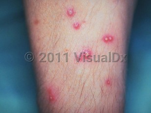 Clinical image of Listeriosis - imageId=232590. Click to open in gallery.  caption: 'Numerous pustules with surrounding erythema on the forearm.'
