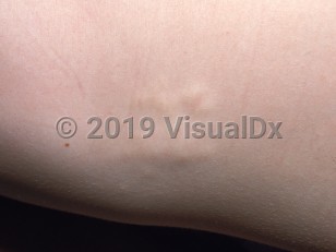 Clinical image of Buschke-Ollendorff syndrome - imageId=2330844. Click to open in gallery.  caption: 'A close-up of smooth, slightly yellowish papules and plaques.'