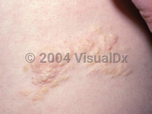 Clinical image of Nevus lipomatosus superficialis - imageId=2331235. Click to open in gallery.  caption: 'A close-up of a cluster of yellowish and light pink papules, plaques, and nodules.'