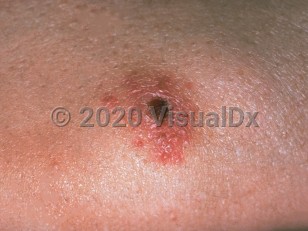Clinical image of Tularemia