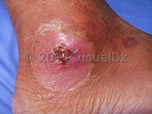 Clinical image of Cutaneous diphtheria - imageId=233476. Click to open in gallery.  caption: 'A pink plaque with a central superficial ulcer and a surrounding collarette of scale on the ankle.'