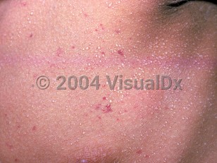 Clinical image of Miliaria crystallina - imageId=2346509. Click to open in gallery.  caption: 'A close-up of myriad tiny vesicles on the chest.'
