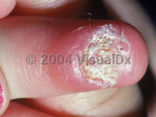 Clinical image of Nail candidiasis - imageId=2350574. Click to open in gallery.  caption: 'A thinned and markedly dystrophic fingernail with erythema and edema of the proximal nailfold.'