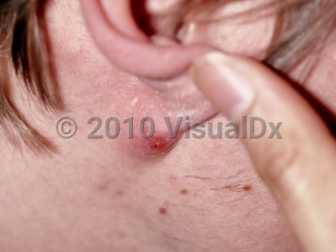 Clinical image of Carbuncle - imageId=235068. Click to open in gallery.  caption: 'A pink nodule with a central crust behind the ear.'