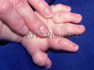 Clinical image of Turner syndrome