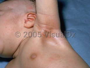 Clinical image of Congenital adrenal hyperplasia - imageId=2356223. Click to open in gallery. 