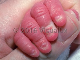 Clinical image of Ankyloblepharon-ectodermal dysplasia-cleft lip and palate syndrome - imageId=2358684. Click to open in gallery.  caption: 'Thin, shortened nail plates.'