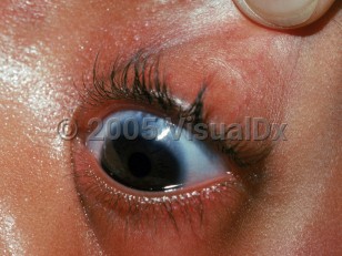 Clinical image of Osteogenesis imperfecta - imageId=2359360. Click to open in gallery.  caption: 'Bluish color of the sclera.'