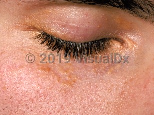 Clinical image of Xanthelasma palpebrarum - imageId=236041. Click to open in gallery.  caption: 'Yellow and brownish papules coalescing to form plaques on and around the eyelids.'