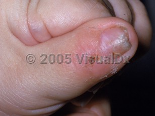 Clinical image of Lesch-Nyhan syndrome - imageId=2363526. Click to open in gallery. 