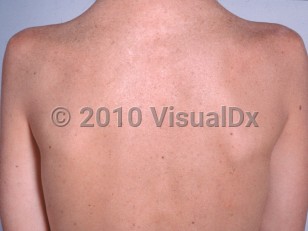 Clinical image of Cockayne syndrome