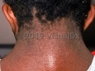 Clinical image of Noonan syndrome - imageId=2365987. Click to open in gallery.  caption: 'A webbed neck.'