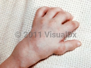 Clinical image of Farber disease - imageId=2366528. Click to open in gallery. 