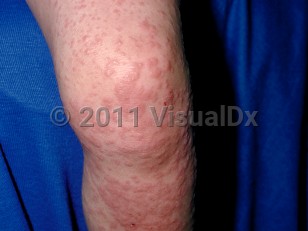 Clinical image of Gianotti-Crosti syndrome - imageId=23668. Click to open in gallery.  caption: 'Multiple erythematous and edematous papules and plaques on the leg.'