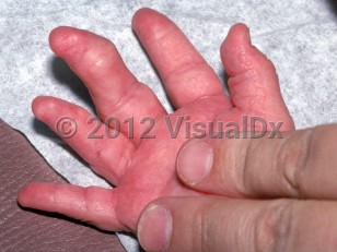 Clinical image of Proteus syndrome